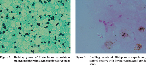 Adrenal Histoplasmosis Diagnosed By Endoscopic Ultrasound Guided Fine Needle Aspiration 8924